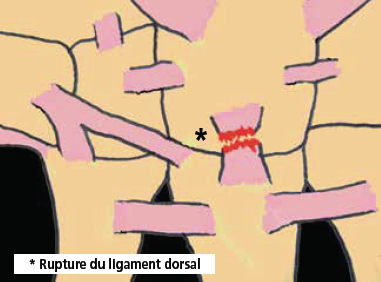 Le carpe bossu du sportif fig14