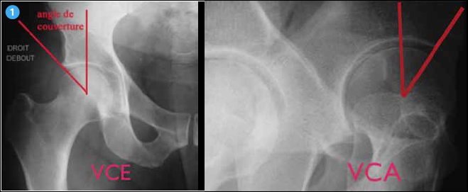 <p>La coxométrie reste en 2013 l’imagerie de référence irremplaçable pour appréhender la morphologie acétabulaire. On rappelle les valeurs normales de la couverture acétabulaire : VCE > 25°, VCA > 25°.</p>
<p> </p>
