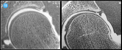 <p>La réalisation d’un arthroscanner de hanche sous traction (hanche décoaptée) augmente la qualité de visualisation du cartilage acétabulaire et de sa jonction avec le labrum. C’est précisément à ce niveau que les lésions cartilagineuses sont les plus fréquentes chez le sportif.</p>
<p> </p>
