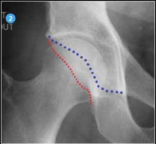 <p>L’angle de couverture est devenu insuffisant pour appréhender la hanche du sportif, car il néglige les parois antérieure et postérieure dont le développement normal est connu : la paroi antérieure (bleu) est moins développée, la paroi postérieure (rouge) se projette au centre de la tête fémorale, les deux parois ne se croisent pas.</p>
<p> </p>
