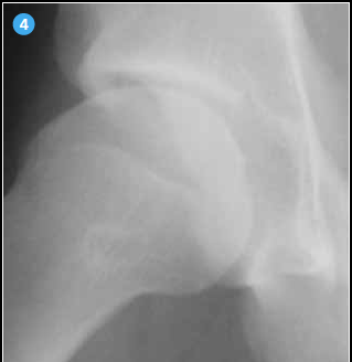 <p>Cette radiographie montre un signe du croisement mais dans ce cas la hanche est dysplasique (VCE < 25°) et la paroi postérieure n’est pas assez développée (elle se projette au tiers médial de la tête fémorale). Une erreur d’interprétation serait grave car elle pourrait conduire à un geste d’acétabuloplastie antérieure qui aggraverait la dysplasie.</p>
<p> </p>
