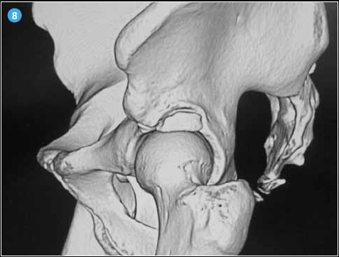 <p>Reconstruction 3D d’un scanner du bassin où l’on voit que l’os acetabuli peut se situer en zone portante et compromettre la répartition harmonieuse des contraintes coxo-fémorales.</p>
<p> </p>
