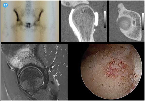 <p><b>Piège classique chez ce sportif de 22 ans présentant une douleur de hanche à radiographie normale : oedème osseux IRM, fixation à la scintigraphie, l’arthroscanner ne montre pas de lésion du labrum mais un nidus typique. Le diagnostic d’ostéome ostéoïde est confirmé par l’histologie.</b></p>
<p> </p>
