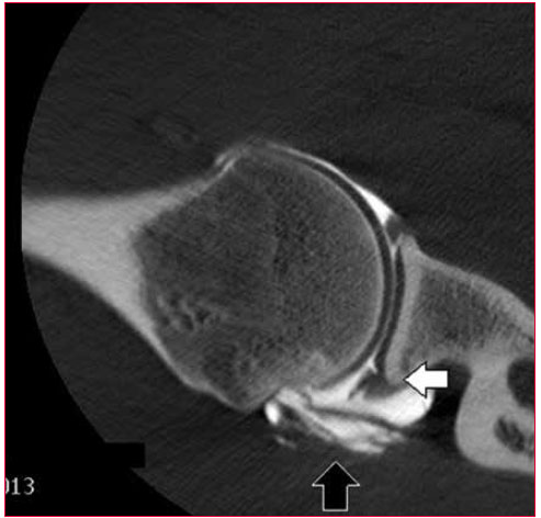 <div>
<p>Arthroscanner en position d’armer (ABER). Mise en contact du versant profond du supra-épineux et du labrum postérieur. Ouverture du clivage du supra-épineux montrant la perte de substance massive.</p>
<p> </p>
</div>
<div></div>
