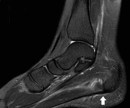 <p>IRM, coupe sagittale T2 FatSat. Œdème en périphérie de l’aponévrose plantaire superficielle, mais épaisseur normale.</p>
<div></div>
