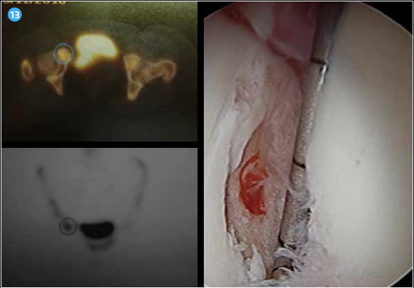 <p>L’hyperfixation scintigraphique est le signe d’une coxopathie géodique active.</p>
