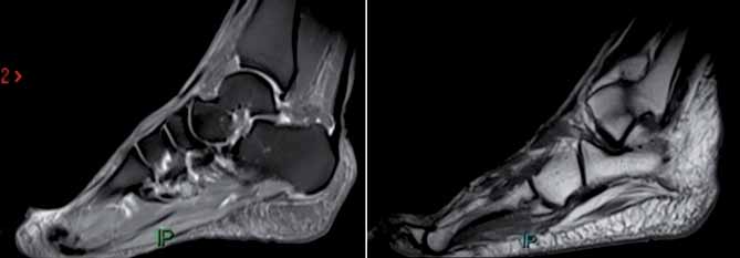 <p>L’examen IRM met en évidence un discret épaississement de l’insertion du faisceau médial de l’aponévrose plantaire en rapport avec une aponévrosite chronique.</p>
