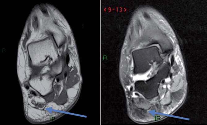 <p>L’examen IRM met en évidence un discret épaississement de l’insertion du faisceau médial de l’aponévrose plantaire en rapport avec une aponévrosite chronique.</p>
