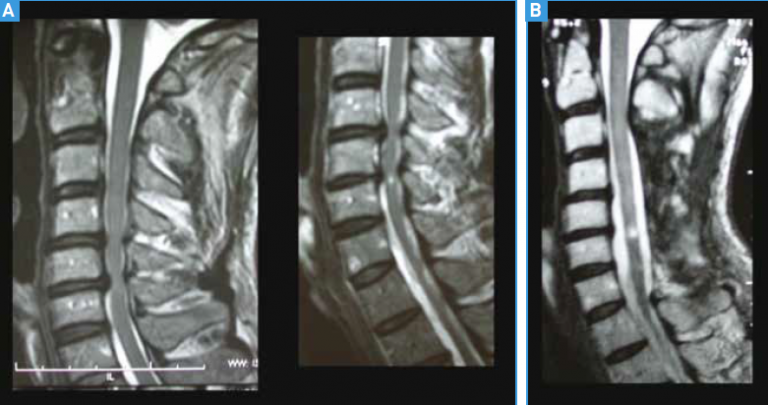 <p>Avant et après laminectomie.</p>
<p>A : Myélopathie cervicarthrosique par canal cervical étroit, décompensée par une double discopathie.<br />
B : IRM de contrôle à 3 mois, après laminectomie. L’hypersignal intra-médullaire est toujours présent, malgré la bonne décompression anatomique de la moelle et l’efficacité du recalibrage canalaire.</p>