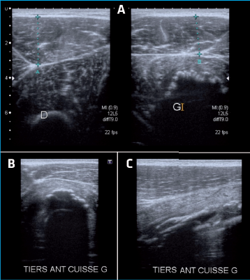 <p>A : coupes axiales comparatives du muscle droit fémoral (27 mm de diamètre à droite, 21 mm à gauche) ; B : coupes axiales loge antérieure de cuisse droite ; C : coupe sagittale loge antérieure de cuisse droite.</p>
