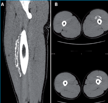 <p>Scanner : zone hypodense contenant des calcifi cations en couronne à centre clair, séparées de l’os. a : reconstruction sagittale ; B : coupes axiales.</p>
