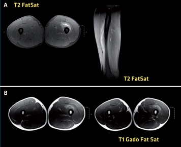 <p>IRM. A : coupes axiale et sagittale en T2, FatSat œdème des fibres musculaires ; B : acquisitions axiales en pondération,T1Gado FatSat, rehaussement musculaire focal, les calcifications sont évidemment moins bien mises en évidence que par le scanner.</p>
