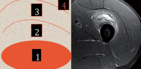 <p>4 : fibres musculaires refoulées ; 3 : travées os mature, +/- amas cartil. ; 2 : ostéoblastes bordés dépôts ostéoïdes ; 1 : fibroblastes jeunes. Rares cellules géantes, capillaires.</p>
