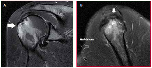 <p><strong>A</strong> : Coupe frontale IRM T2 FatSat. Impactions osseuses du tubercule majeur.</p>
<p><strong>B</strong> : Coupe sagittale IRM T2 FatSat centrée sur le tubercule majeur. Tendinopathie du versant profond du supra-épineux.</p>
