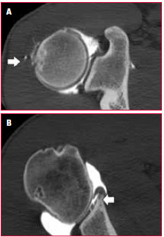 <p><strong>A</strong> : Arthroscanner en coupe axiale. Clivage de la face articulaire du supra-épineux et impaction du tubercule majeur.</p>
<p><strong>B</strong> : Arthroscanner en coupe axiale. Désinsertion du labrum antéro-inférieur et lésion cartilagineuse.</p>
