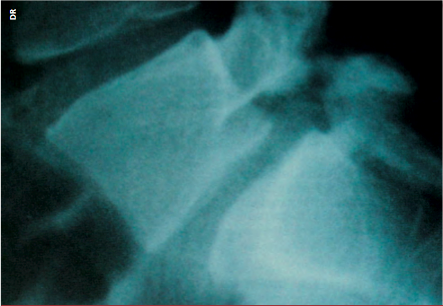 <div title="Page 1">
<div>
<div>
<div>
<p>La radiographie de profil met en évidence la lyse isthmique et le glissement antérieur de stade I de L5 sur S1.</p>
</div>
</div>
</div>
</div>
