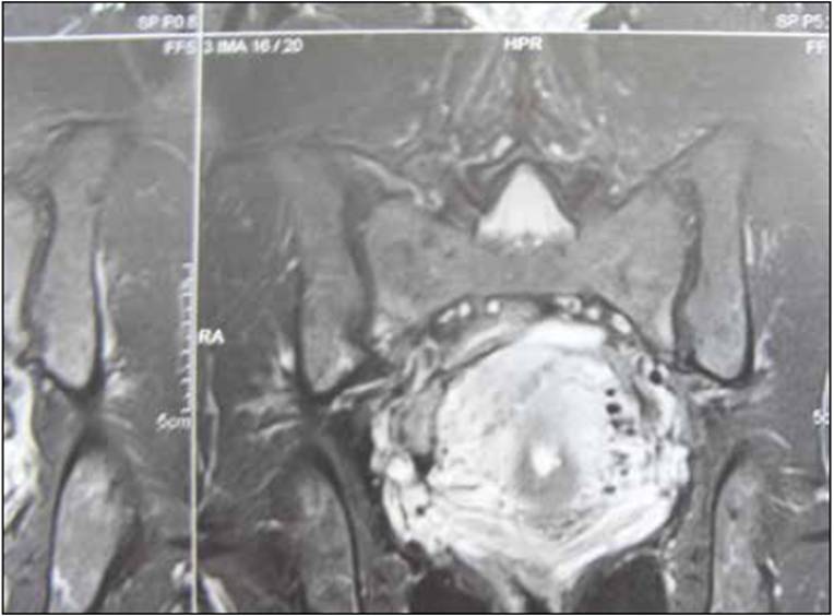 <p>IRM avec injection de gadolinium : fracture de fatigue du sacrum, avec un trait se jetant dans l’interligne articulaire sacro-iliaque.</p>
