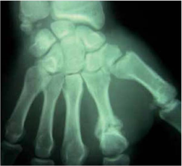 <p>Fracture tubulaire du deuxième métacarpien chez un boxeur professionnel.</p>
