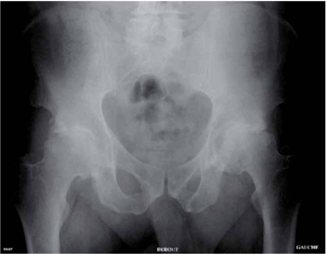 104-rééducation-fig1 – radio bassin – La médecine du sport