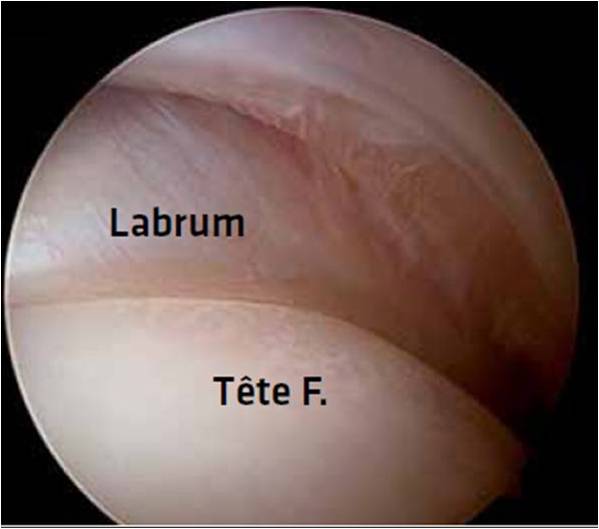 <p>Le labrum acétabulaire est une structure fibreuse richement innervée, insérée sur le sourcil acétabulaire, qui fonctionne comme un joint étanche autour de la tête fémorale. Ce système hydraulique de lubrification est vulnérable lors des mouvements amples, du sport<br />
et des traumatismes. Le labrum lésé est douloureux.</p>
