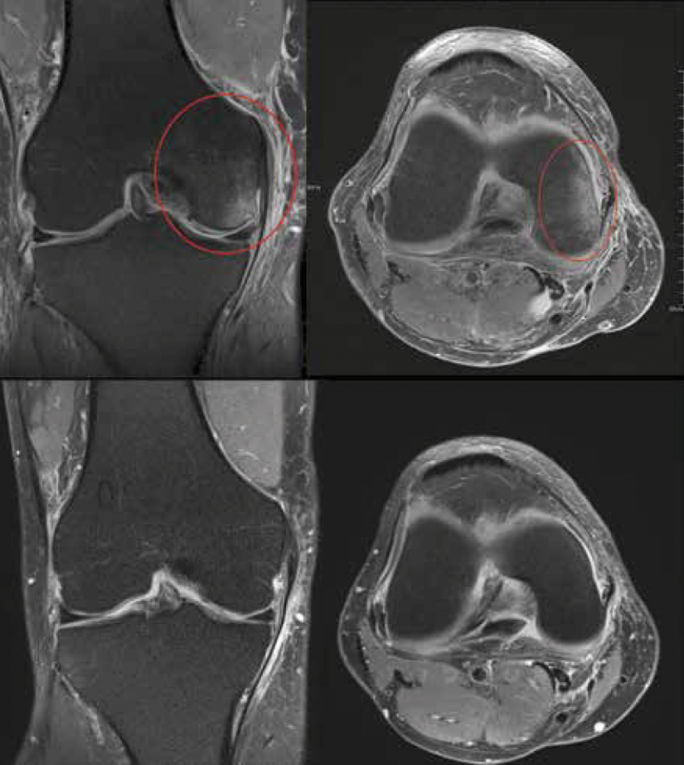 <p>Périméniscite avant et après infiltration : disparition de l’hypersignal réactionnel du condyle.</p>