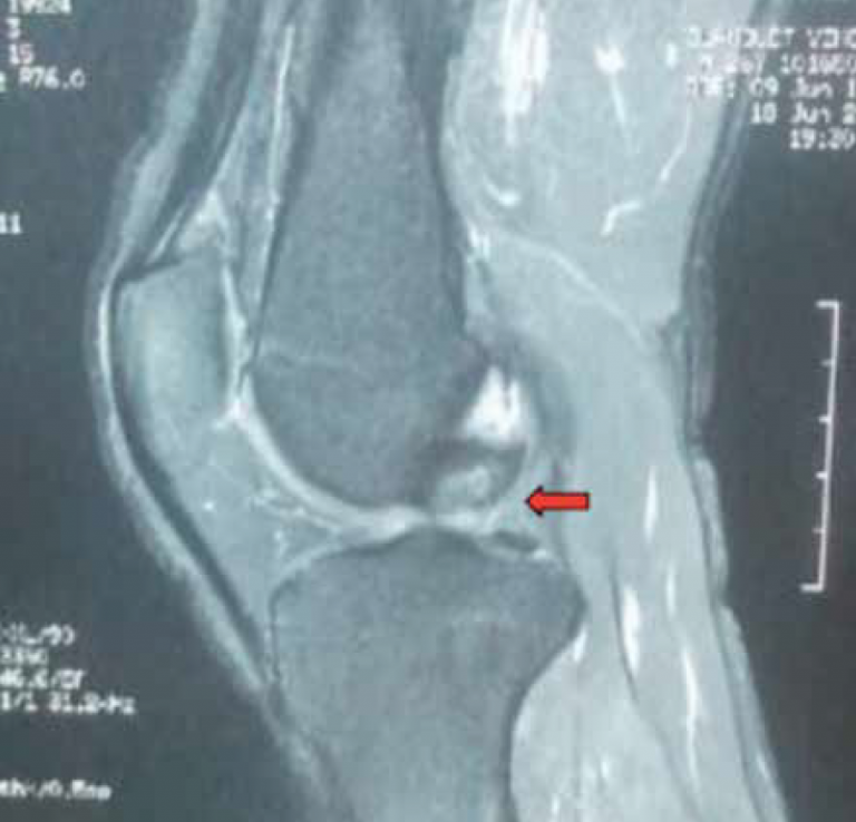 <p>IRM en coupe sagittale objectivant la rupture du LCP (flèche).</p>