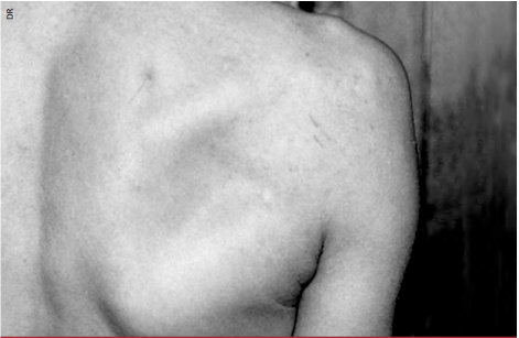 <div title="Page 1">
<div>
<div>
<div>
<p>L’examen clinique met en évidence à l’inspection une nette amyotrophie de la fosse infra-épineuse.</p>
</div>
</div>
</div>
</div>
