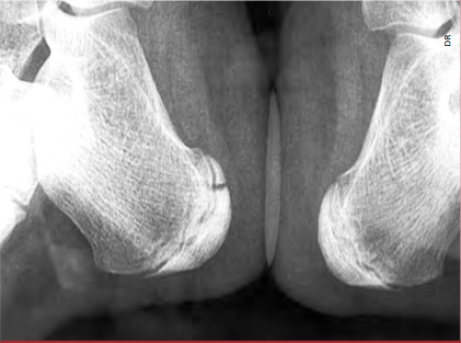 <p>Fracture de l’extrémité inférieure du noyau d’ossification calcanéen gauche.</p>
