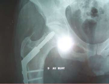 <div title="Page 2">
<div>
<div>
<div>
<p>Radiographie : le clou.</p>
</div>
</div>
</div>
</div>