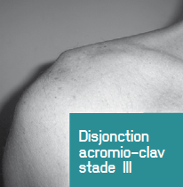 <p>Disjonction acromio-claviculaire stade III.</p>
