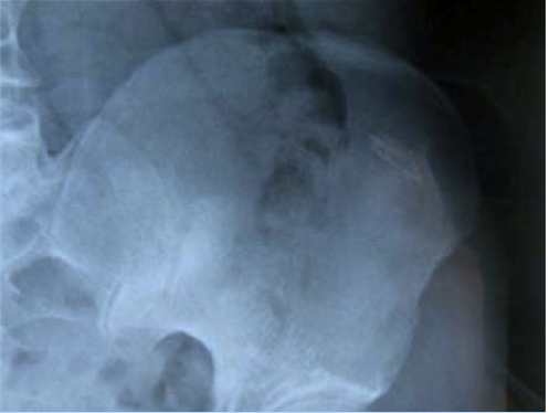 <p>Radiographie à quatre mois : ostéocondensation cicatricielle en dehors de la sacro-ilaque.</p>