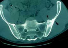 <p>TDM à 3 mois : ostéocondensation associée à une ossification périostée à la face antérieure de l’aile iliaque.</p>
