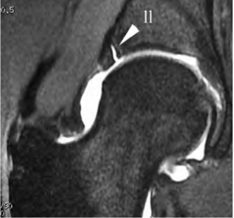 <p>Lésion labrale (ll) mise en évidence sur une coupe frontale d’arthro-IRM. Il s’agit d’une désinsertion large, provoquée par un mouvement de torsion chez une femme de 29 ans, diagnostiquée un an après le traumatisme (douleurs, blocage).</p>
