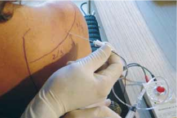 <div title="Page 3">
<div>
<div>
<div>
<p>Repérage du point d’injection, technique du bloc sus- scapulaire à l’échancrure spino-glénoïdienne.</p>
</div>
</div>
</div>
</div>