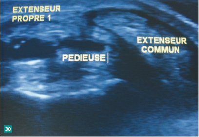 <p>Tendon antérieur, en échographie.</p>
