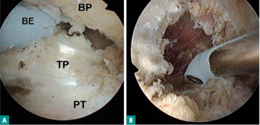 <div title="Page 12">
<div>
<div>
<div>
<p>A : section du tendon du psoas (TP) dans la bourse du psoas (BP) à l’aide d’une sonde d’électrocoagulation (SE) au raz du petit trochanter (PT). B : rétraction du tendon de 1 à 2 cm créant un phénomène d’allongement. Récupération fonctionnelle en quelques semaines.</p>
</div>
</div>
</div>
</div>
