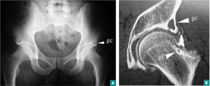 <p>Chez ce jeune sportif de 25 ans, la géode cotyloïdienne gauche n’est en réalité pas isolée (A). Elle communique par un pertuis avec une bulle cartilagineuse ouverte sur l’articulation. L’arthroscanner est donc faussement négatif et l’exploration opératoire met en évidence un effet came très important et un décollement massif du cartilage cotyloïdien. Une géode fémorale est visible sur le scanner (B).</p>
