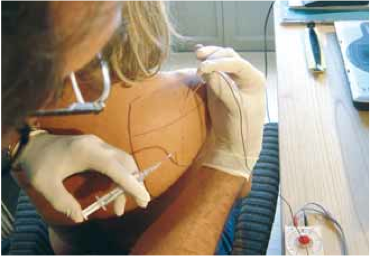 <div title="Page 3">
<div>
<div>
<div>
<p>Position de la patiente, technique du bloc sus-scapulaire à l’échancrure coracoïdienne.</p>
</div>
</div>
</div>
</div>