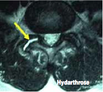 <p>L’IRM met en évidence une hydarthrose.</p>
