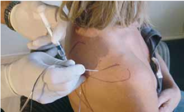 <div title="Page 3">
<div>
<div>
<div>
<p>Repérage du point d’injection, technique du bloc sus-scapulaire à l’échancrure coracoïdienne.</p>
</div>
</div>
</div>
</div>
