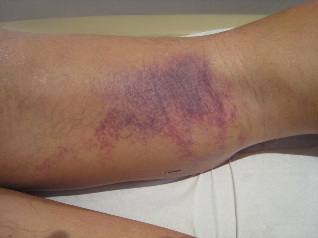 Tendinopathies de la face postérieure du genou Anatomie et prise en