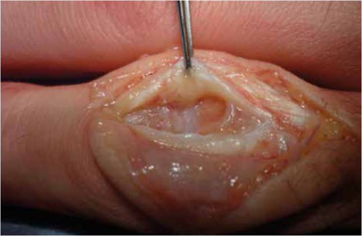tendon lesion