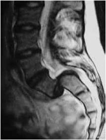 Figure 4 - Vue IRM de profil dune spondyloptose.