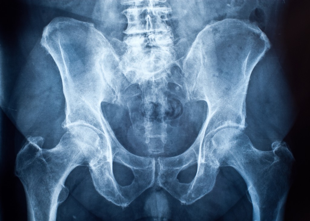 Pelvis x-ray