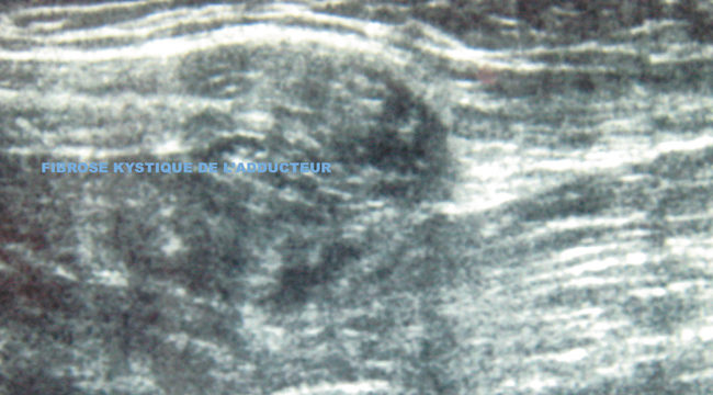 pubalgie-23