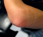 Lésions pigmentées brunes chez un jeune judoka